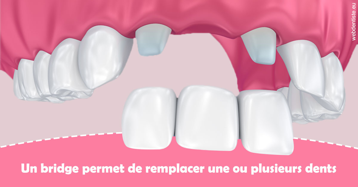 https://dr-patrice-gasser.chirurgiens-dentistes.fr/Bridge remplacer dents 2