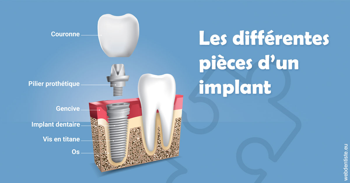 https://dr-patrice-gasser.chirurgiens-dentistes.fr/Les différentes pièces d’un implant 1